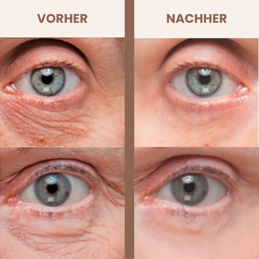 Luméa Augenstraffer