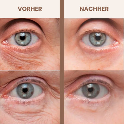 Luméa Augenstraffer